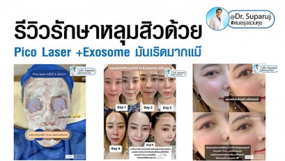 รีวิวรักษาหลุมสิวด้วย Pico Laser +Exosome มันเริดมากแม๊